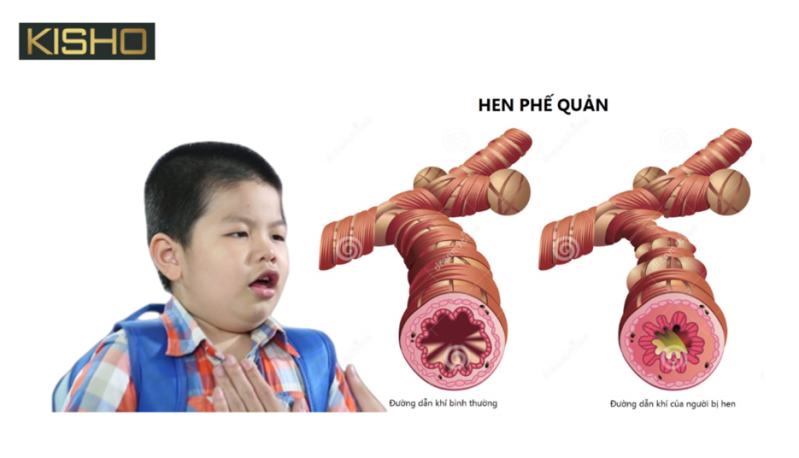 trieu-chung-hen-suyen-o-tre