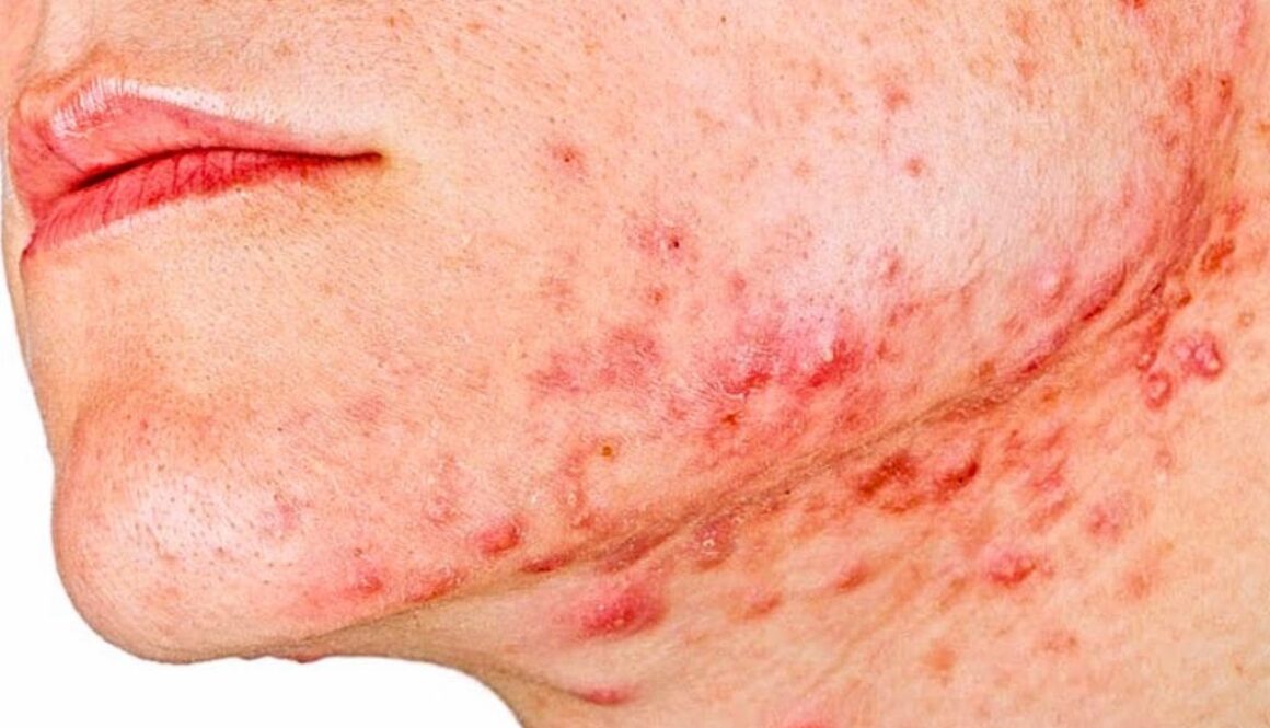 Nóng trong người nổi mụn