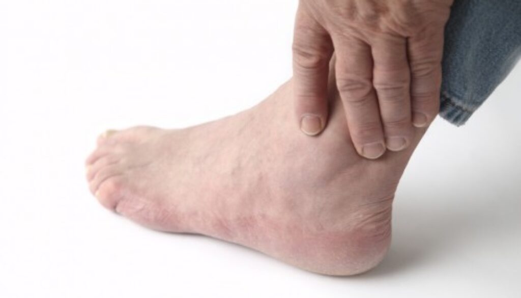 dau-hieu-cua-benh-gout