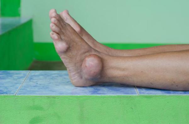 Bệnh Gout Có Gây Mệt Mỏi Không